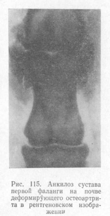 анкилоз сустава первой фаланги на почве деформирующего остеоартрита